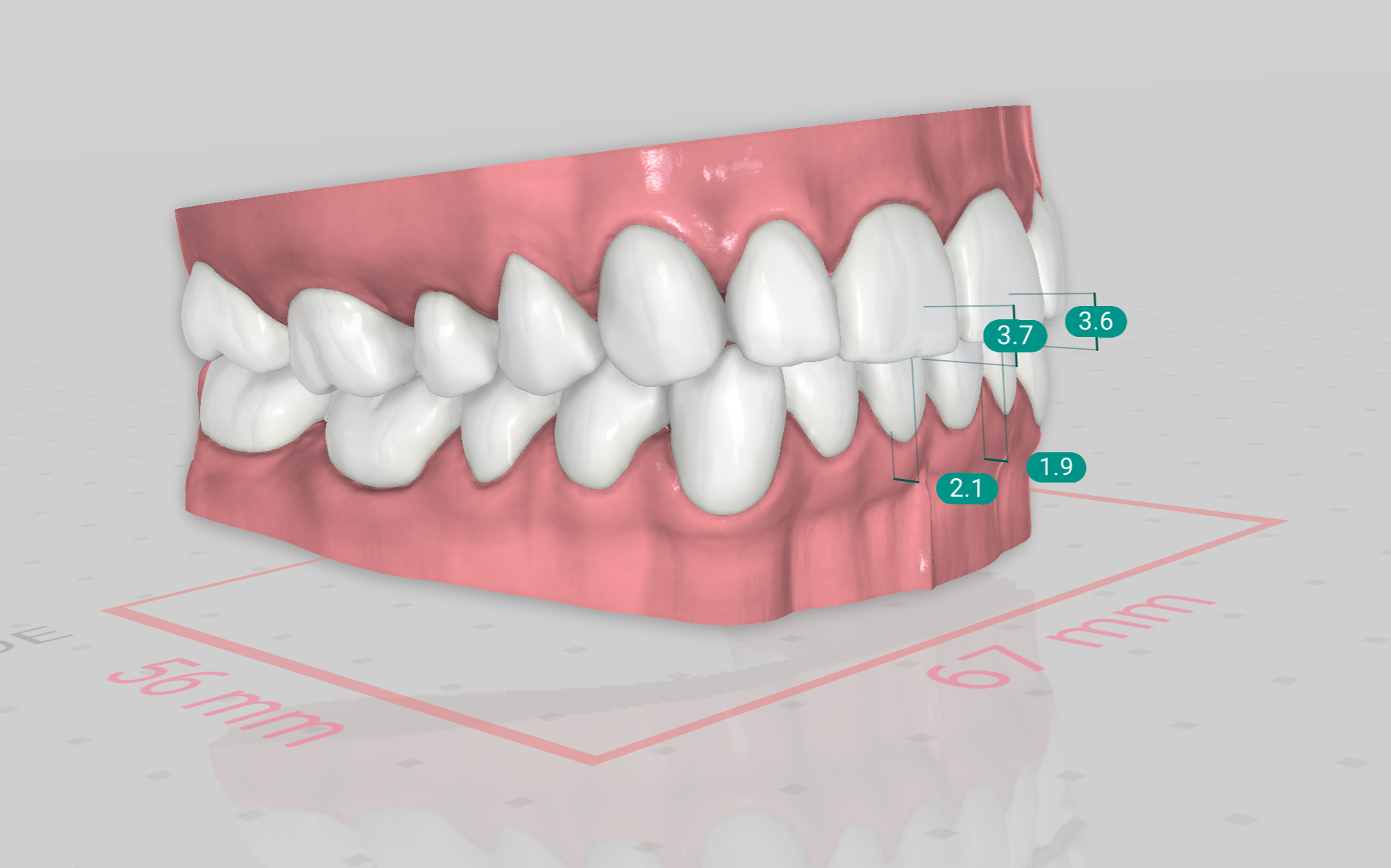 Modelo 3D de la mordida con medidas de sobremordida