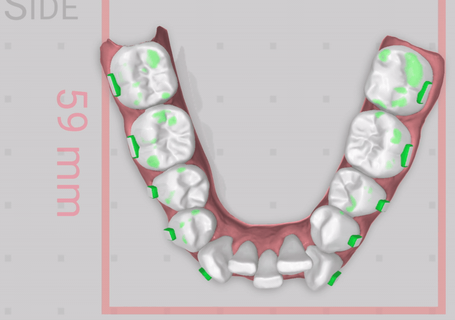 Modelo digital 3D de la arcada con medidas de cada pieza dental